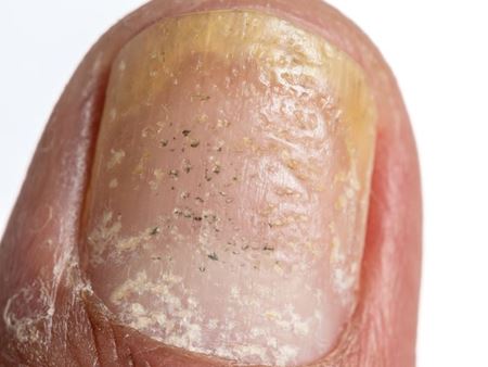psoriasis