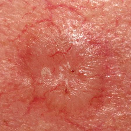 carcinome basocellulaire