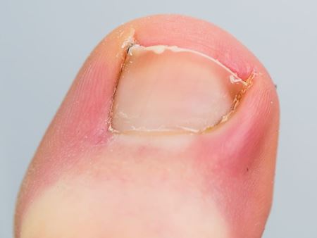 ongle incarné