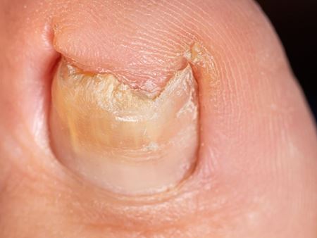 ongle en pince