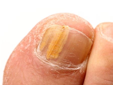 mycose ongle