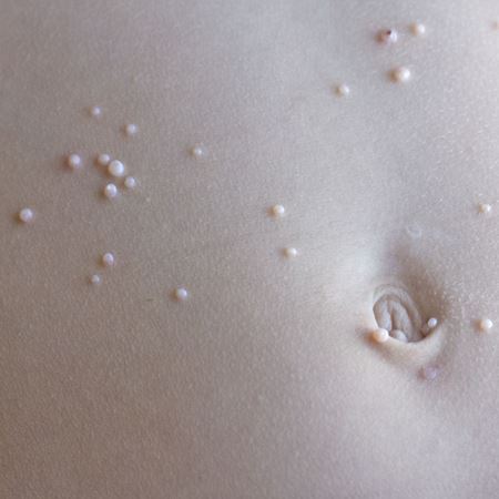 molluscum